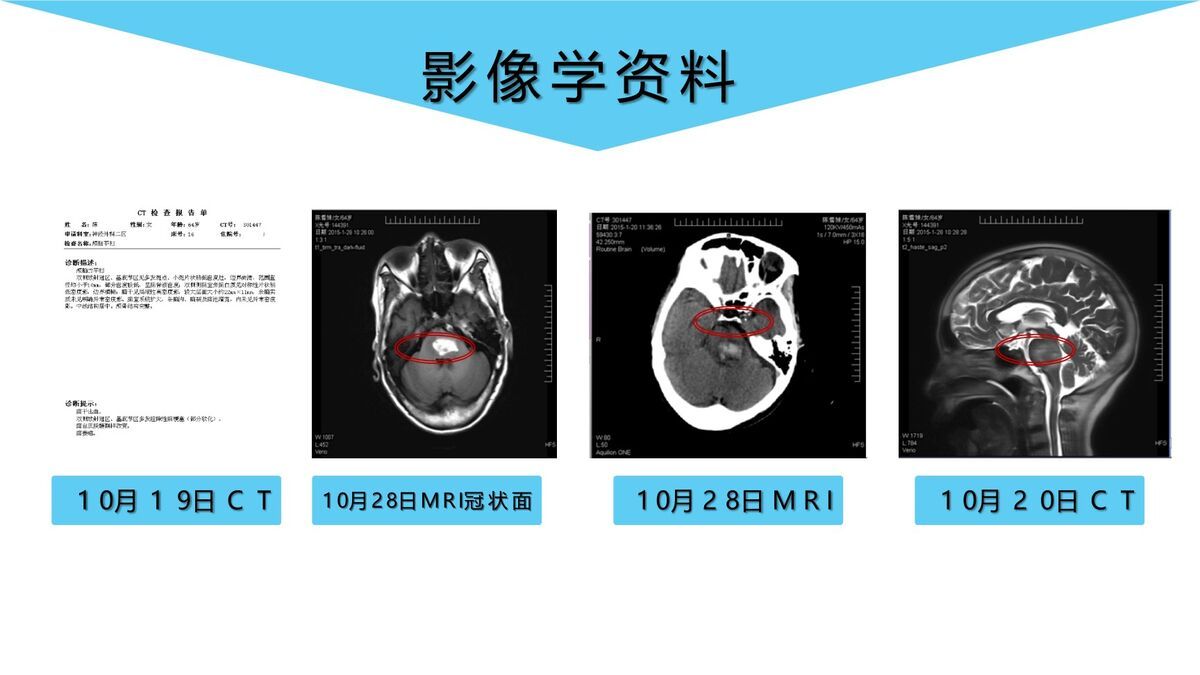 脑出血护理个案研究汇报PPT模板4