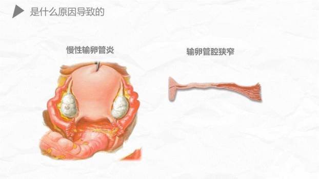 薄荷绿简约风异位妊娠护理PPT模板8