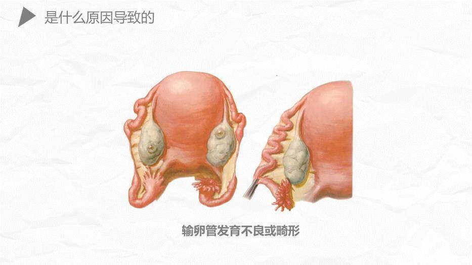 薄荷绿简约风异位妊娠护理PPT模板9