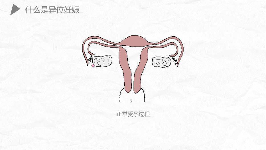 薄荷绿简约风异位妊娠护理PPT模板2