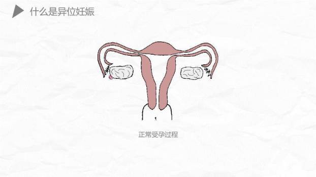 薄荷绿简约风异位妊娠护理PPT模板2