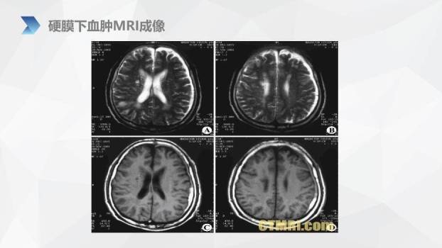 肤色插画风亚急性硬膜下血肿护理查房PPT模板4