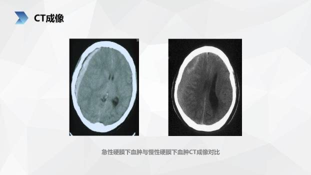 肤色插画风亚急性硬膜下血肿护理查房PPT模板5