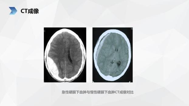肤色插画风亚急性硬膜下血肿护理查房PPT模板6