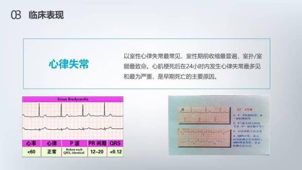 红色3D急性心梗护理查房PPT模板9