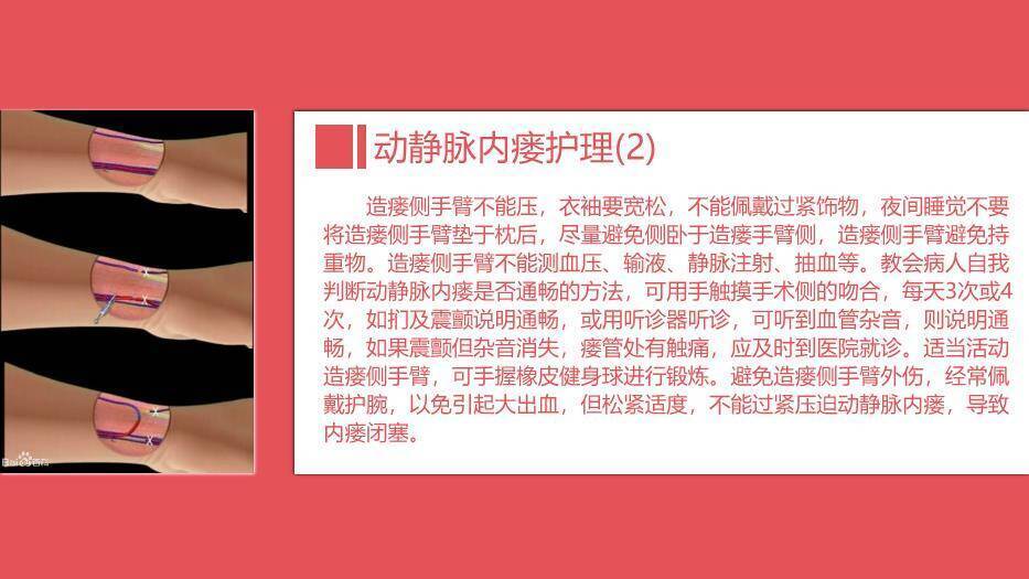 红色血透病人的护理PPT模板7