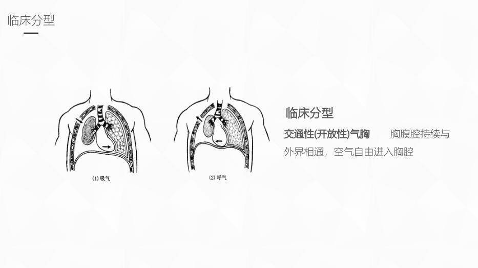 黄色插画风结核性胸膜炎护理业务学习课件PPT模板1