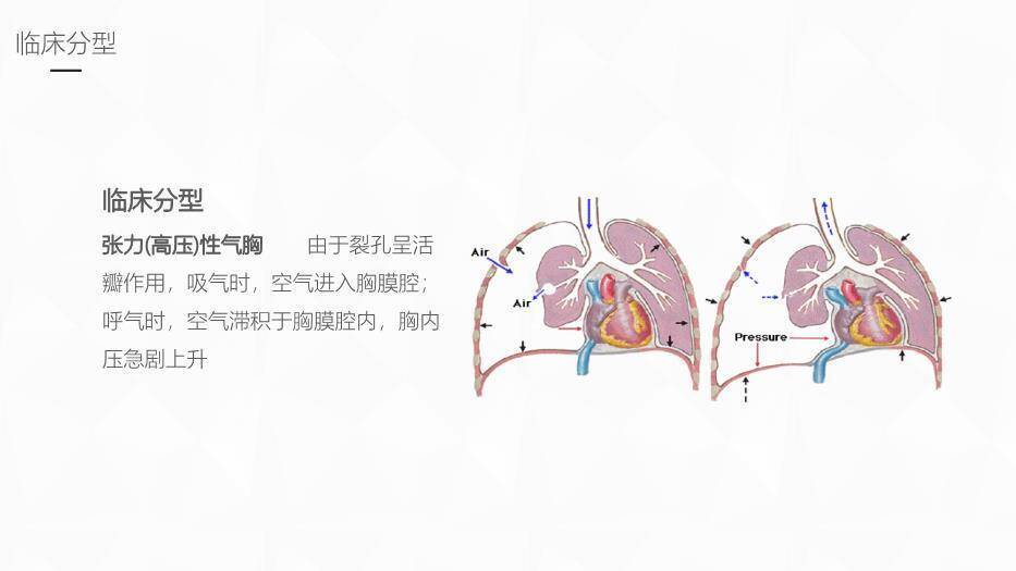 黄色插画风结核性胸膜炎护理业务学习课件PPT模板2