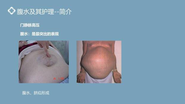 灰蓝色极简几何风肝硬化腹水病人的护理PPT模板3
