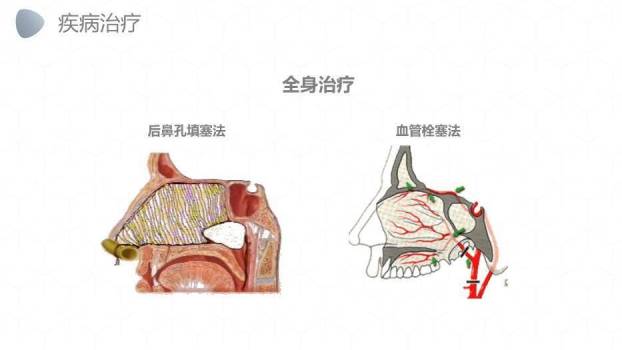 灰色卡通风鼻出血护理业务PPT模板7