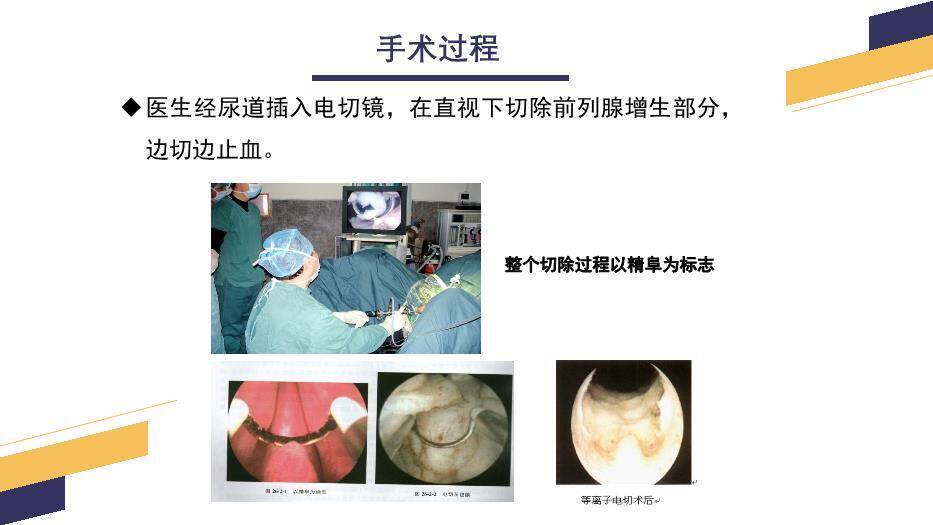 黄色几何风经尿道前列腺电切手术配合PPT模板5