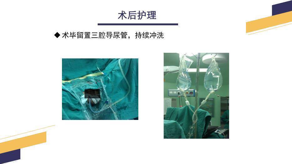 黄色几何风经尿道前列腺电切手术配合PPT模板6