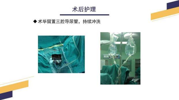 黄色几何风经尿道前列腺电切手术配合PPT模板6