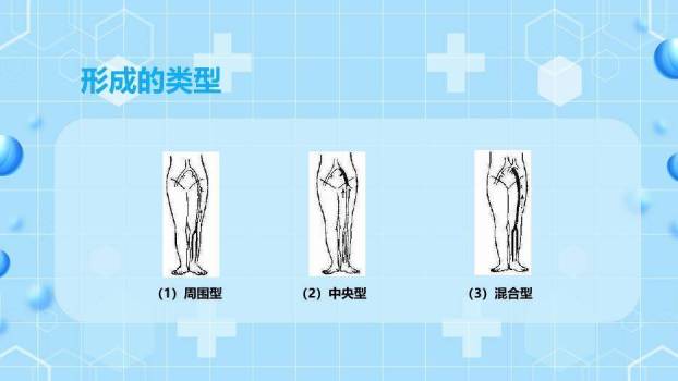 蓝色卡通插画风下肢静脉血栓的护理查房PPT模板6