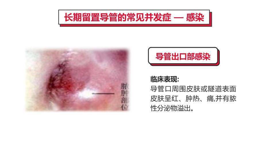 红色血液透析留置导管护理PPT模板8