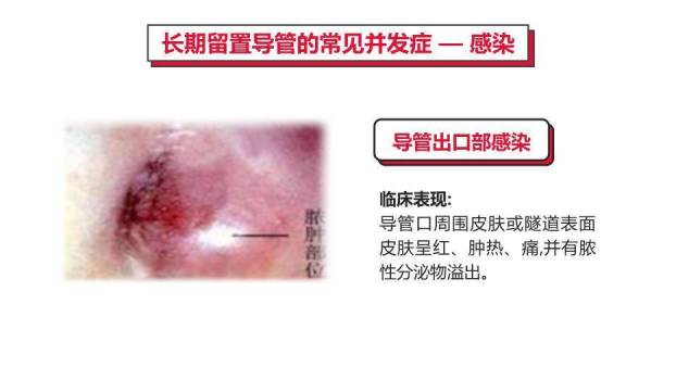 红色血液透析留置导管护理PPT模板8