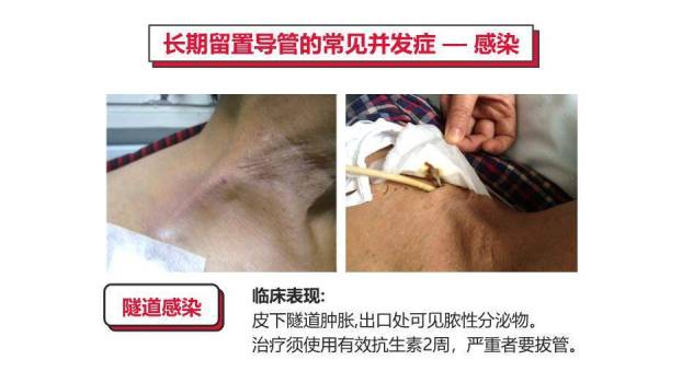 红色血液透析留置导管护理PPT模板9