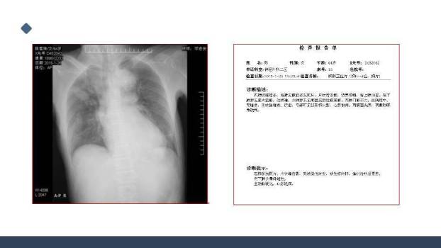 蓝色极简风一例桥脑出血的护理个案分享PPT模板2
