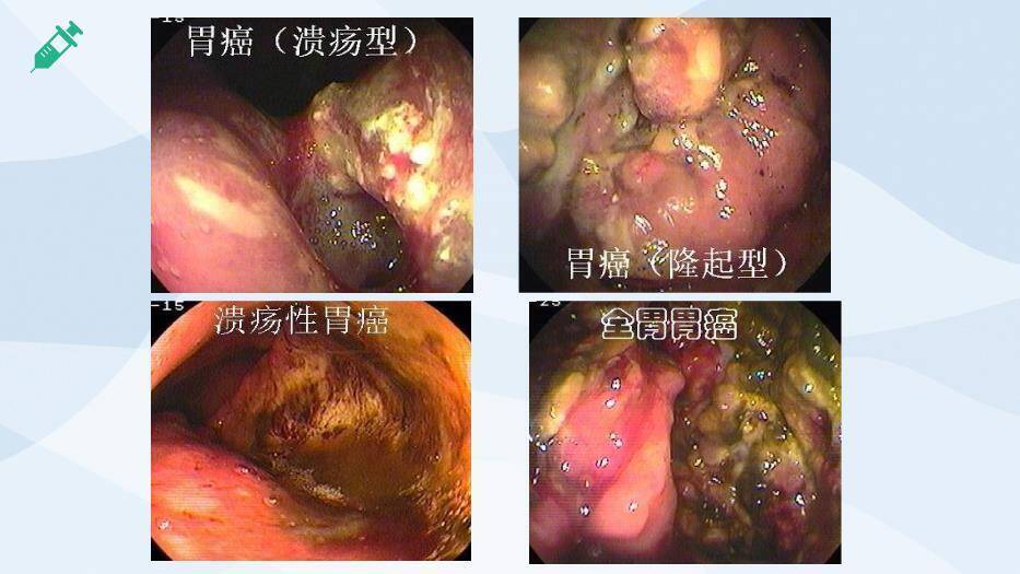 天蓝色微立体胃癌PPT模板8