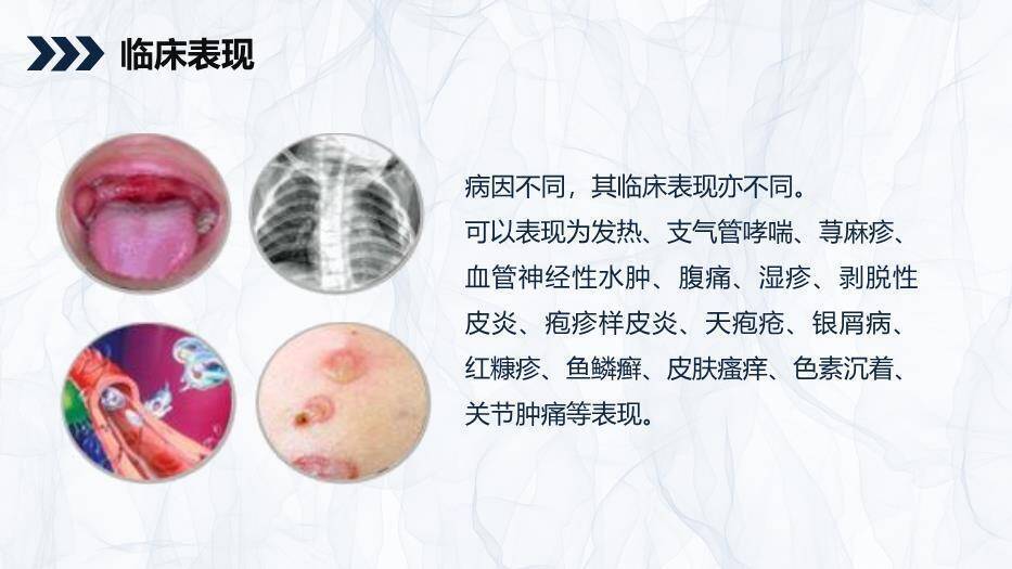 银灰色简约风嗜酸性粒细胞增多症护理查房PPT模板2